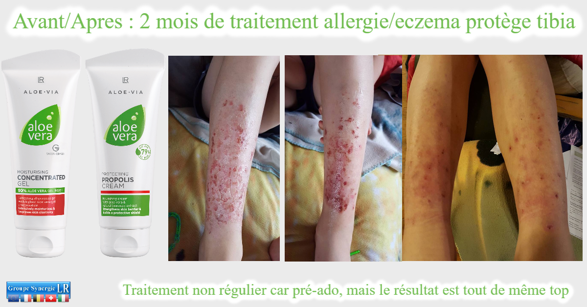 Allergie et eczema au tibia